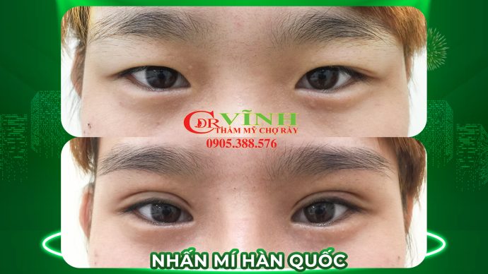 4-nhan-mi-han-quoc-bac-si-vinh-khoa-tham-my-benh-vien-cho-ray