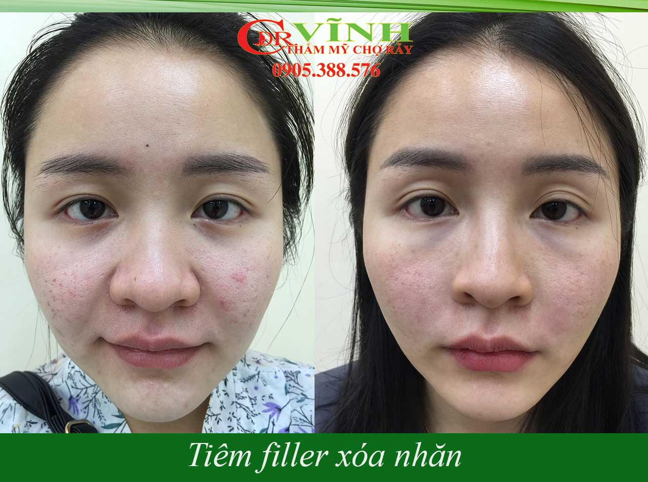 Tiêm filler là gì? Có hại gì không? Nên tiêm filler loại nào?