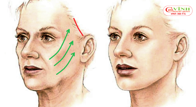 Căng da mặt mini cải thiện được những vấn đề nào trên gương mặt