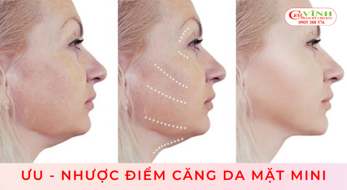 Ưu – nhược điểm của căng da mặt mini
