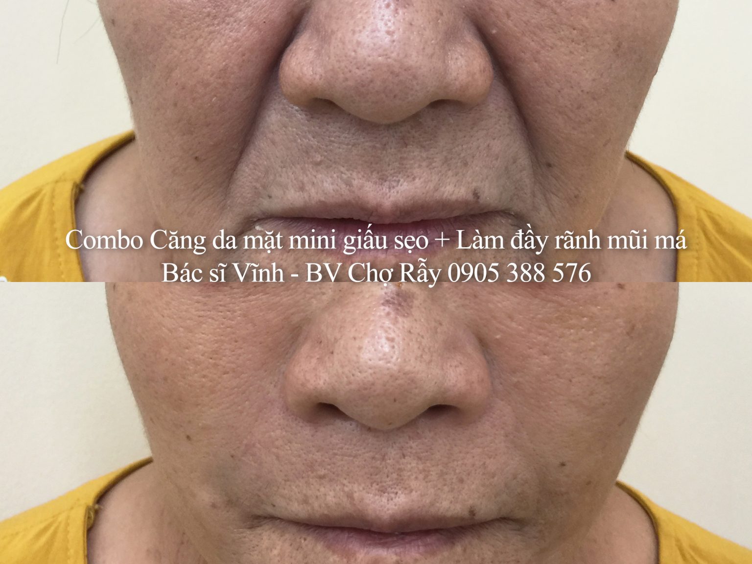 combo cang da mat mini giau seo lam day ranh mui ma