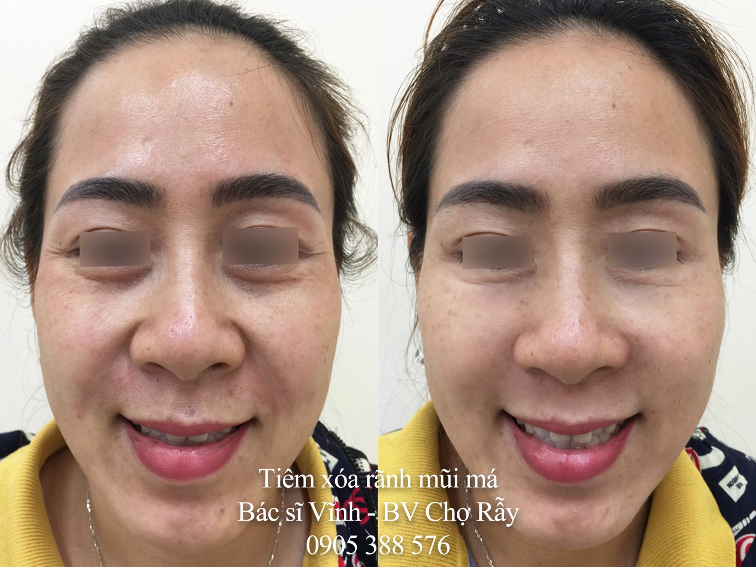 tiem lam day ranh mui ma