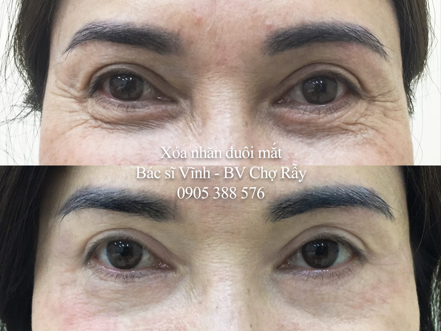 xoa nhan duoi mat bac si vinh cho ray