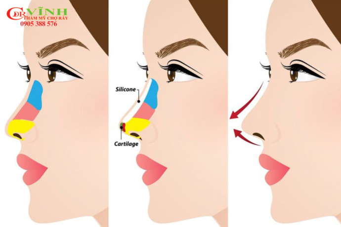 Nâng mũi đặt sống không can thiệp đầu mũi có an toàn không? Hình ảnh mô phỏng nâng mũi đặt sống không can thiệp đầu mũi