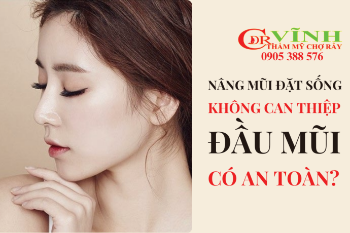 Nâng mũi đặt sống không can thiệp đầu mũi