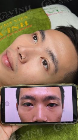 Mắt sụp mí nên cắt mí hay treo cung chân mày? Hinh-anh-khach-hang-cat-mi-tai-phong-kham-bac-si-le-hoang-vinh-cho-ray