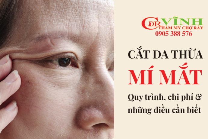 Cắt da thừa mí mắt: quy trình, chi phí và những điều cần biết