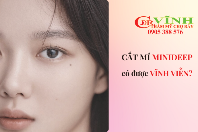 Cắt mí minideep có được vĩnh viễn không