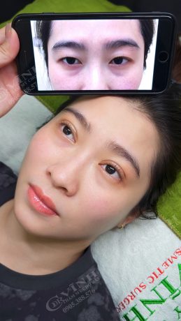 Cắt mí minideep có được vĩnh viễn không? Chi phí & lưu ý Hình ảnh khách hàng thực hiện cắt mí minideep tại Phòng khám Chuyên khoa Thẩm mỹ Tiến sĩ Bác sĩ Lê Hoàng Vĩnh