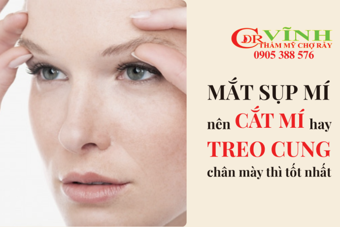 Mắt sụp mí nên treo cắt mí hay treo cung chân mày là tốt nhất