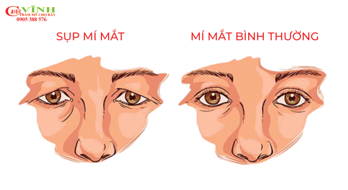 Mắt sụp mí nên cắt mí hay treo cung chân mày? nhu-the-nao-la-mi-mat-bi-sup