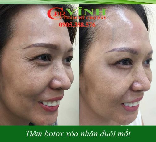 Tiêm botox xóa nhăn có hại không? Tìm hiểu rủi ro và lợi ích Tiêm botox xóa nhăn bác sĩ Vĩnh - khoa thẩm mỹ bệnh viện Chợ Rẫy