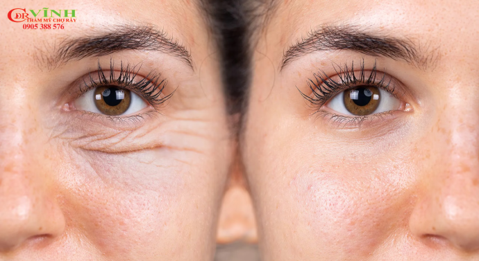 Tiêm botox xóa nhăn có hại không? Tìm hiểu rủi ro và lợi ích Tiêm botox xóa nhăn có hại không