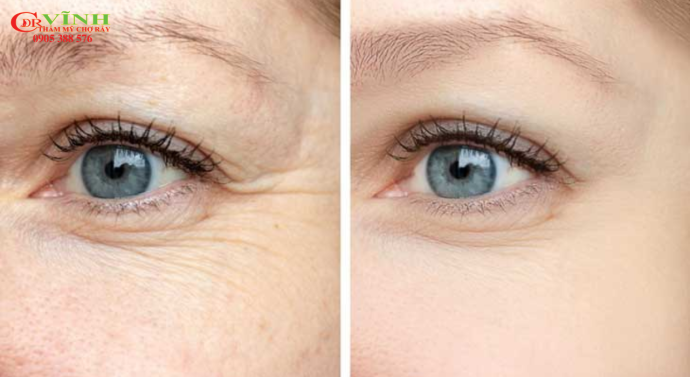 Những phương pháp căng da mặt trẻ hóa da phổ biến hiện nay 2025 Tiêm botox xóa nhăn mắt Bác sĩ Lê Hoàng Vĩnh