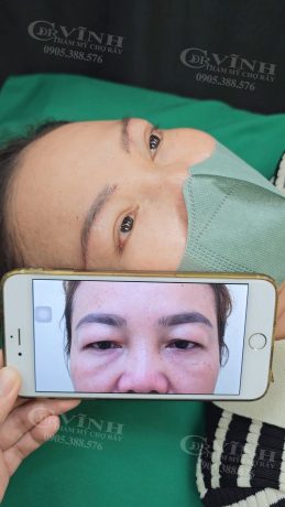 Lấy mỡ bọng mắt trên là gì? Cập nhật giá 2025 & Lưu ý quan trọng Hình ảnh kết quả khách hàng thực hiện lấy mỡ mí mắt trên - Bác sĩ Vĩnh Chợ Rẫy