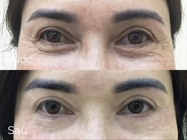 Tiêm botox xóa nhăn đuôi mắt giá bao nhiêu? Giá tiêm botox xóa nhăn mắt