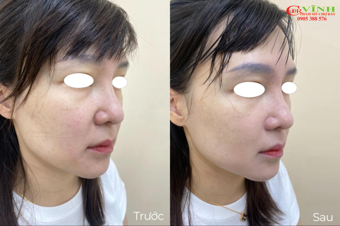 Nâng cơ Hifu có hiệu quả không? Giải đáp chi tiết Kết quả ngay sau khi thực hiện nâng cơ Hifu tại Phòng khám Thẩm mỹ Dr Vĩnh - Chợ Rẫy
