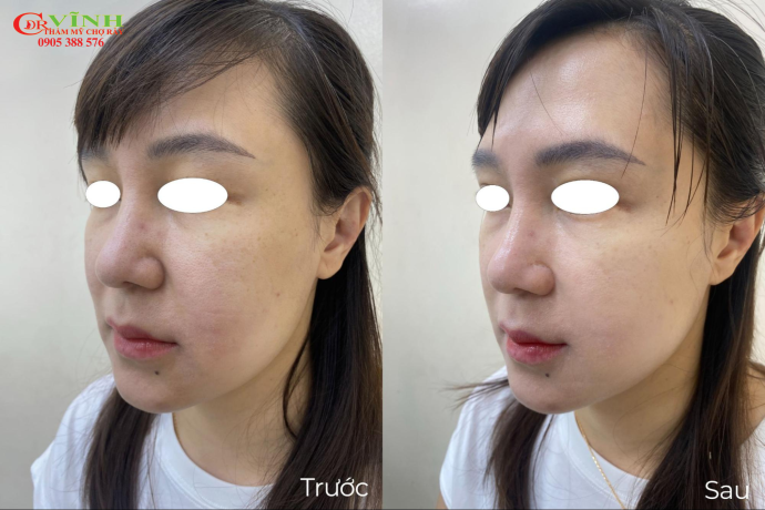 Nâng cơ Hifu có hiệu quả không? Giải đáp chi tiết Kết quả ngay sau khi thực hiện nâng cơ Hifu tại Phòng khám Thẩm mỹ Dr Vĩnh - Chợ Rẫy