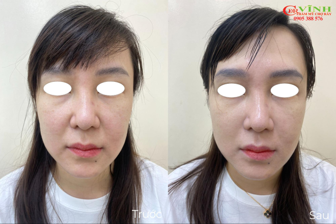 Nâng cơ Hifu có hiệu quả không? Giải đáp chi tiết Hình ảnh khách hàng ngay sau khi thực hiện nâng cơ hifu tại Phòng khám Thẩm mỹ Ts.Bs Lê Hoàng Vĩnh - Chợ Rẫy