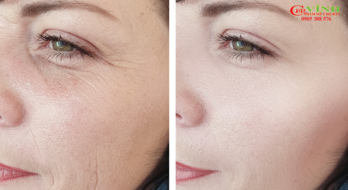 Tiêm botox xóa nhăn đuôi mắt giá bao nhiêu? Tiêm botox xóa nhăn đuôi mắt giá bao nhiêu