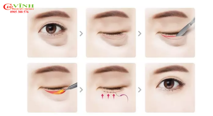 Phẫu thuật lấy mỡ bọng mắt - review cắt mí dưới Bác sĩ Vĩnh Mô phỏng quy trình cắt mí dưới Bác sĩ Lê Hoàng Vĩnh - Chợ Rẫy