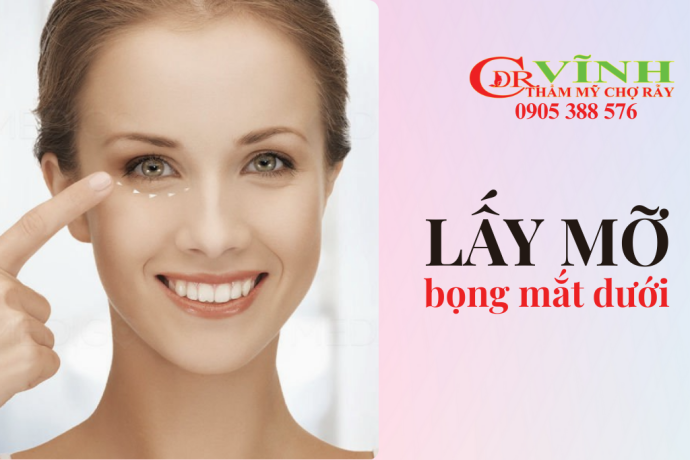 Phẫu thuật lấy mỡ bọng mắt dưới - review cắt mí dưới