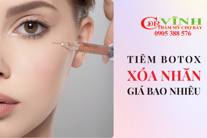 Tiêm botox xóa nhăn đuôi mắt giá bao nhiêu