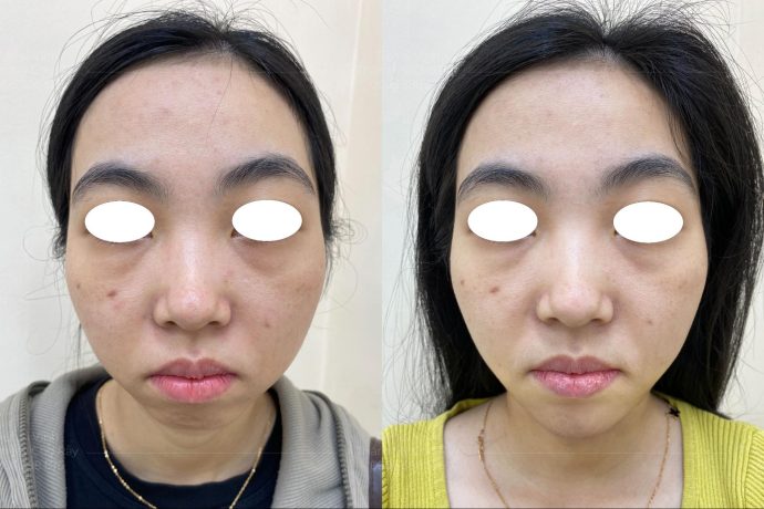 Độn cằm giữ được bao lâu? Giải đáp chi tiết từ chuyên gia Hình ảnh trước và sau khi độn cằm tại Phòng khám Phẫu thuật Thẩm mỹ DR VĨNH