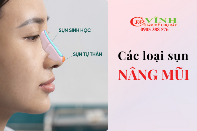 Các loại sụn nâng mũi phổ biến hiện nay