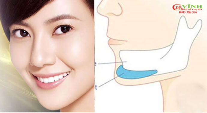 Độn cằm giữ được bao lâu? Giải đáp chi tiết từ chuyên gia Độn cằm giữ được bao lâu