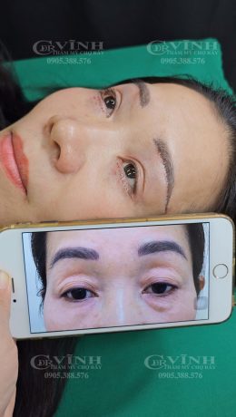Nâng cung chân mày ở đâu đẹp, uy tín, giá tốt tại TP. HCM Hình ảnh trước và sau khi thực hiện nâng cung chân mày
