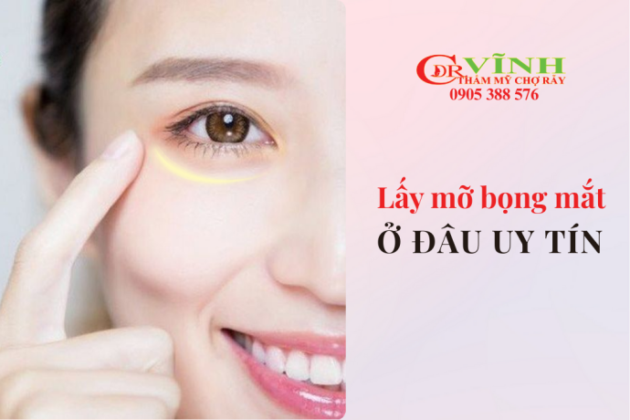 Lấy mỡ bọng mắt ở đâu uy tín