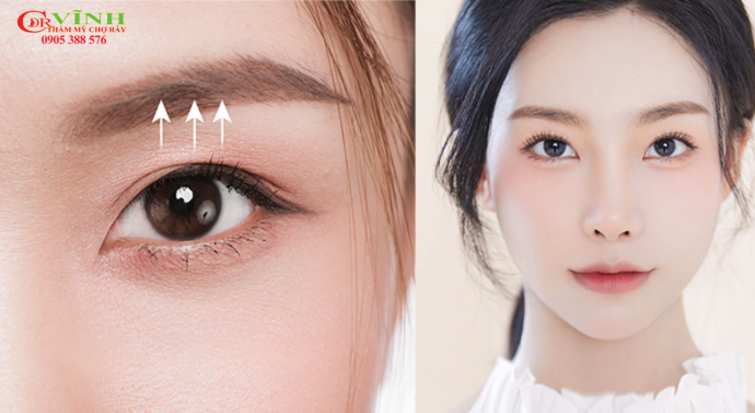 Nâng cung chân mày ở đâu đẹp, uy tín, giá tốt tại TP. HCM Nâng cung chân mày là gì? Địa chỉ nâng cung chân mày uy tín