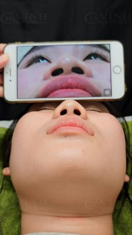 Thu gọn cánh mũi giá bao nhiêu tiền? Ở đâu uy tín? Hình ảnh trước và sau khi thu gọn cánh mũi tại Phòng khám Tiến sĩ Vĩnh - Chợ Rẫy