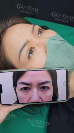 Tiêu chí để chọn bác sĩ thẩm mỹ mắt giỏi, uy tín Hình ảnh nâng cung chân mày bảo toàn nếp mí tự nhiên tại Phòng khám Tiến sĩ Vĩnh - Chợ Rẫy