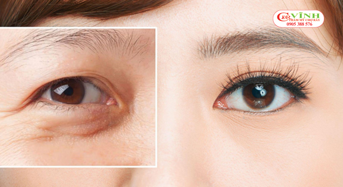 Tiêu chí để chọn bác sĩ thẩm mỹ mắt giỏi, uy tín Tiêu chí để chọn bác sĩ thẩm mỹ mắt giỏi - thẩm mỹ mắt tự nhiên hài hòa