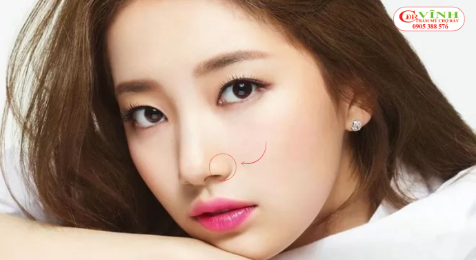 Thu gọn cánh mũi giá bao nhiêu tiền? Ở đâu uy tín? Thu gọn cánh mũi bao nhiêu tiền - thu gọn cánh mũi là gì