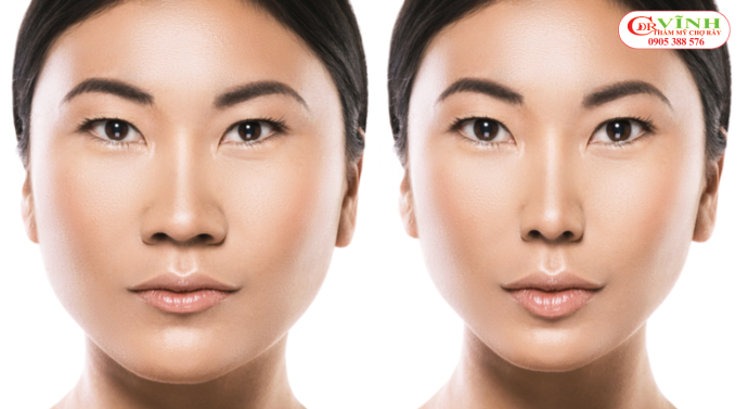 Thu gọn cánh mũi giá bao nhiêu tiền? Ở đâu uy tín? Thu gọn cánh mũi giá bao nhiêu - khi nào nên thu gọn cánh mũi