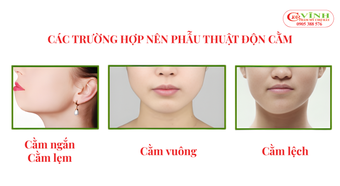 Các trường hợp nên phẫu thuật độn cằm