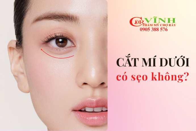 Cắt mí dưới có để lại sẹo không