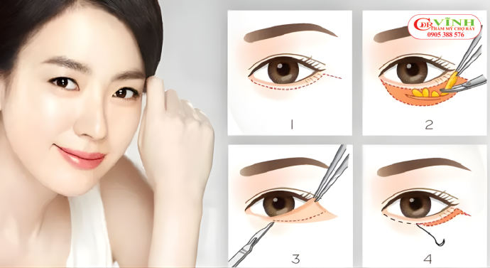Cắt mí dưới có để lại sẹo không? Giải đáp cùng Tiến sĩ Vĩnh - Chợ Rẫy Cắt mí dưới có để lại sẹo không - Quy trình cắt mí dưới