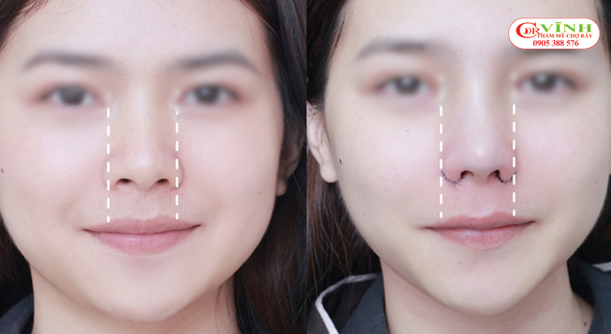 Cuộn cánh mũi là gì? - Khi nào nên thực hiện cuộn cánh mũi