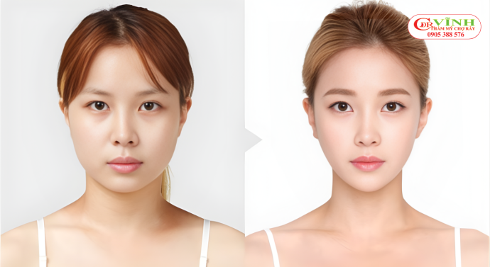 Độn cằm bao lâu thì lành? Quy trình hồi phục chi tiết từ A-Z Độn cằm bao lâu thì lành - quá trình hồi phục sau độn cằm