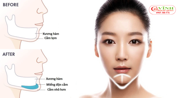 Độn cằm giá bao nhiêu - phương pháp thực hiện