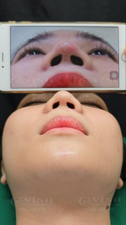 Hình ảnh trước và sau khi cuộn cánh mũi tại Phòng khám Thẩm mỹ Tiến sĩ Lê Hoàng Vĩnh - Chợ Rẫy