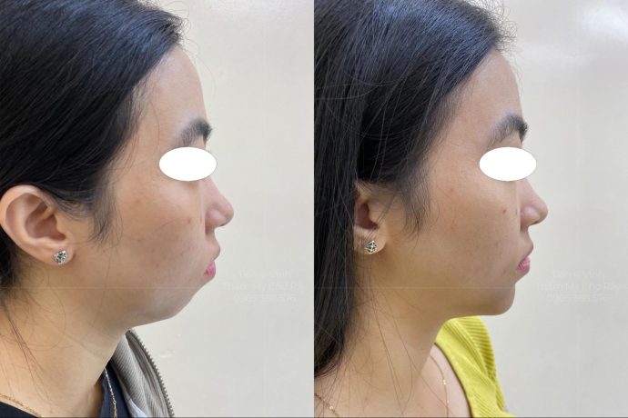 Hình ảnh trước và sau khi phẫu thuật độn cằm tại Phòng khám Thẩm mỹ Tiến sĩ Vĩnh - Chợ Rẫy