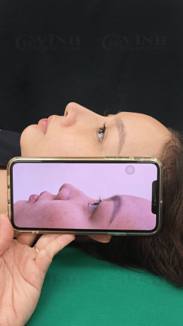 Muốn nâng mũi tự nhiên nhưng sợ “giả” 5 nguyên tắc vàng cần nhớ Nâng mũi tự nhiên Bác sĩ Vĩnh - Chợ Rẫy