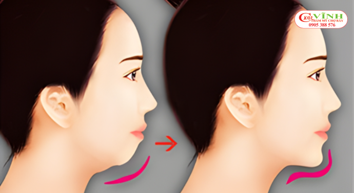 Phẫu thuật độn cằm giá bao nhiêu