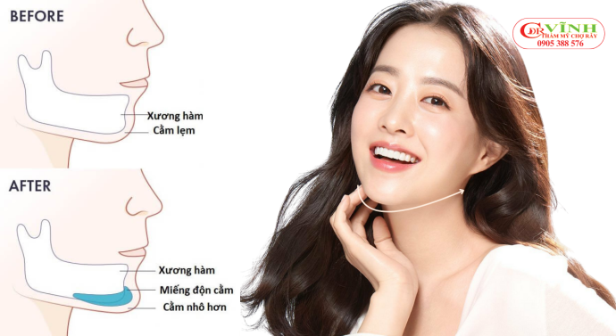 Phẫu thuật độn cằm - Ưu điểm của phương pháp độn cằm Silicon