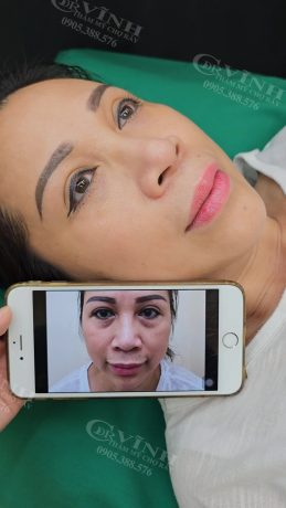 Hình ảnh trước và sau khi thẩm mỹ căng da mặt tại Phòng khám Thẩm mỹ Tiến sĩ Vĩnh Chợ Rẫy